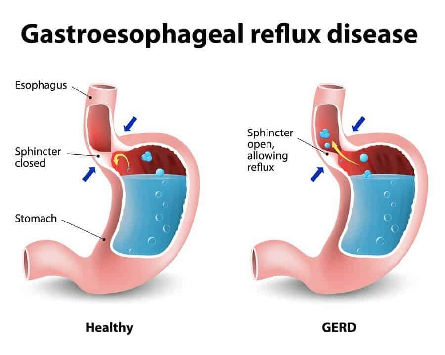 what is acid reflux disease